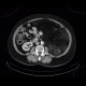 Liposarcoma, retroperitoneal: CT - Computed tomography